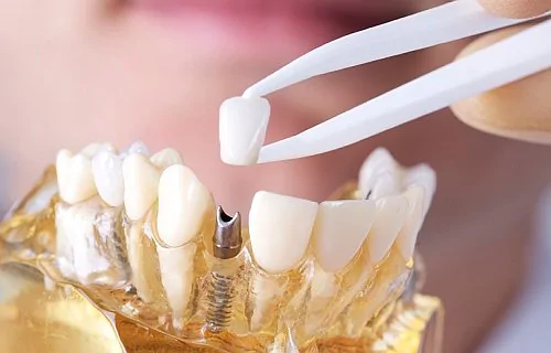 Акция на протезирование зубов коронкой из диоксид циркония