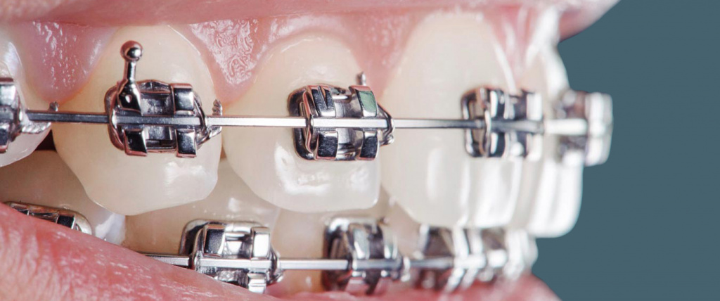 Фиксация брекета при потере (эстетического)