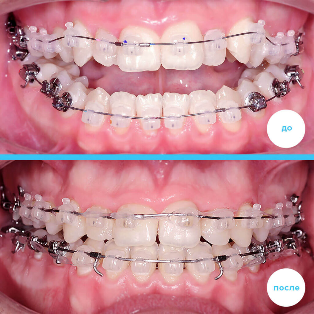 Фиксация брекета при потере (эстетического)