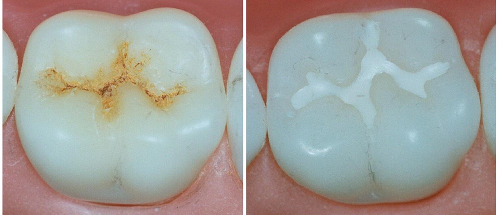 Временные пломбы