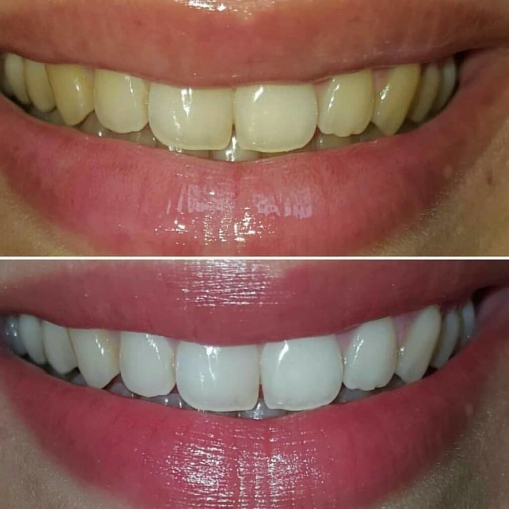 Отбеливание зубов