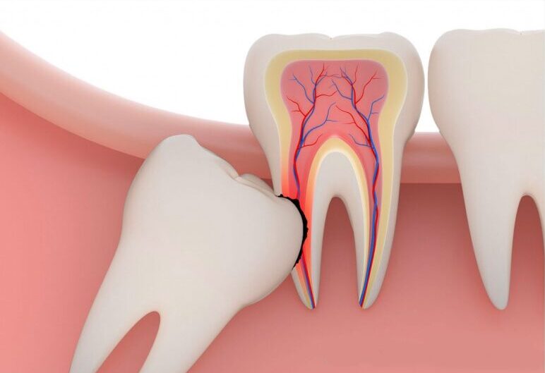 Операция удаления 8-го зуба (мин.)