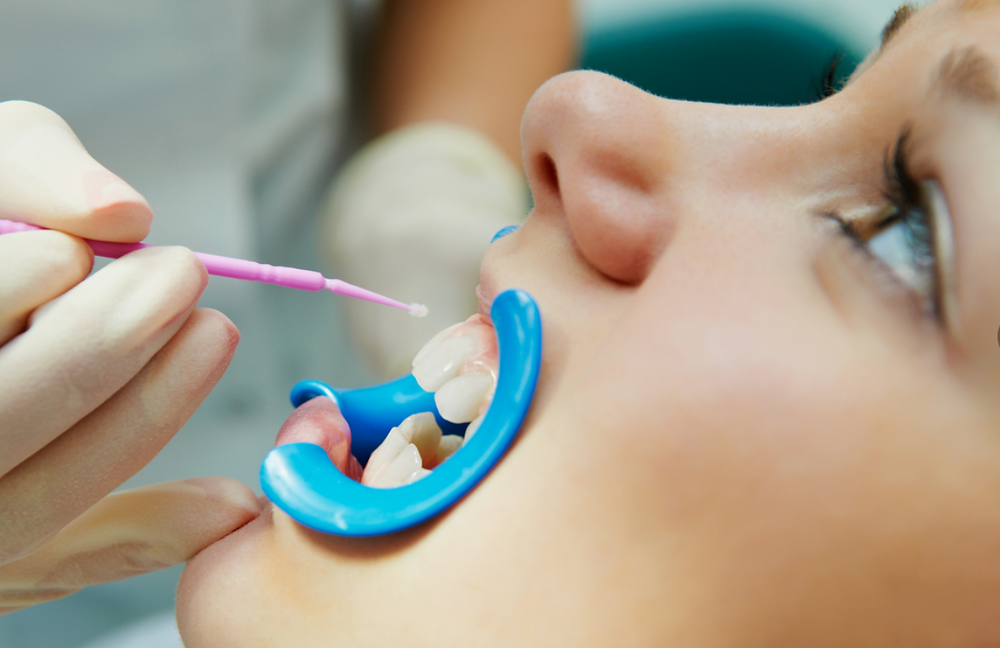 Укрепление зубов