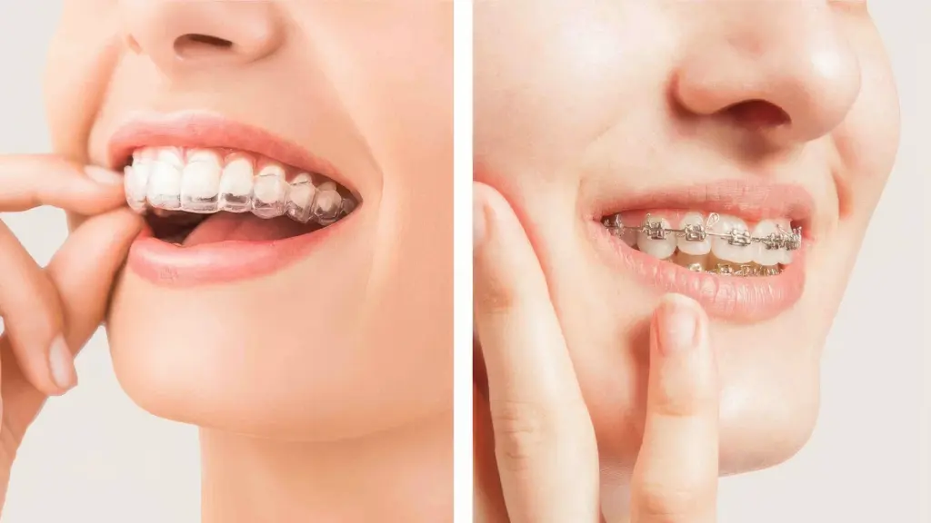Исправление прикуса: брекеты или элайнеры?
